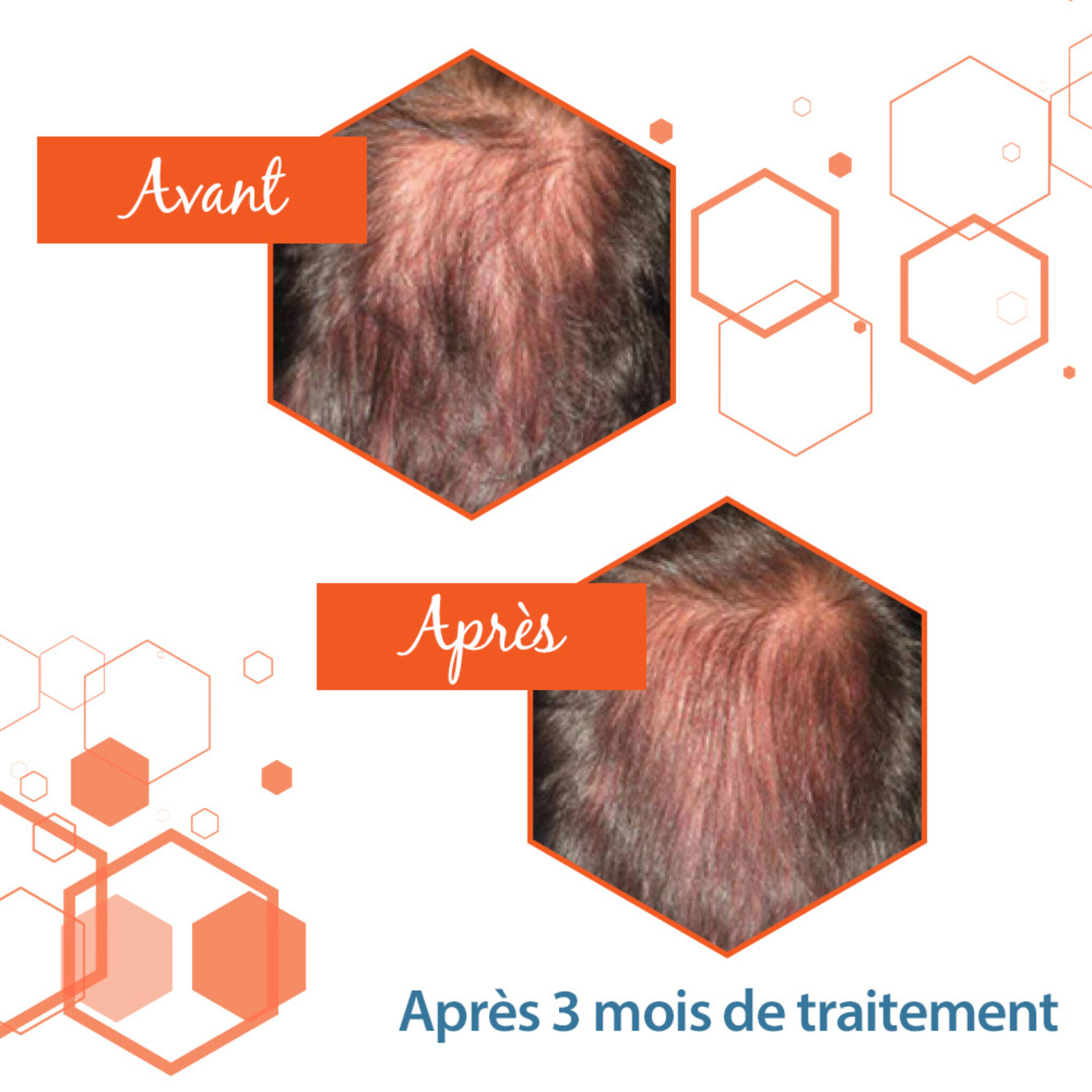 Spironolactone Pour La Croissance Des Cheveux. Guide 2022